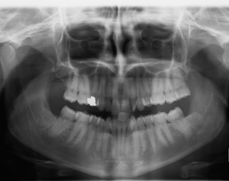 panoramic xray after the extractions