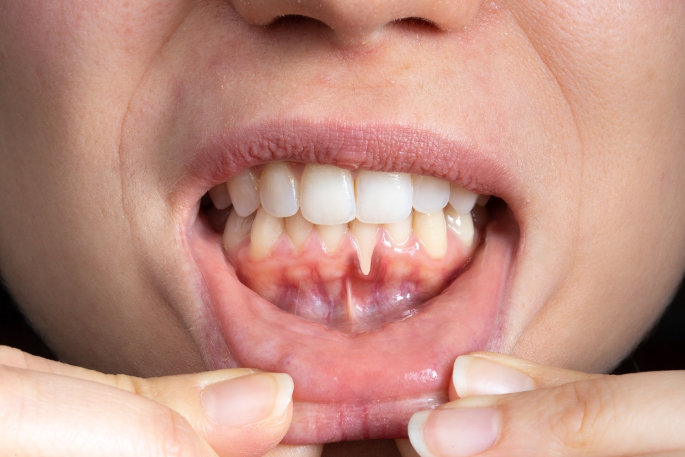 can you treat gum disease at home