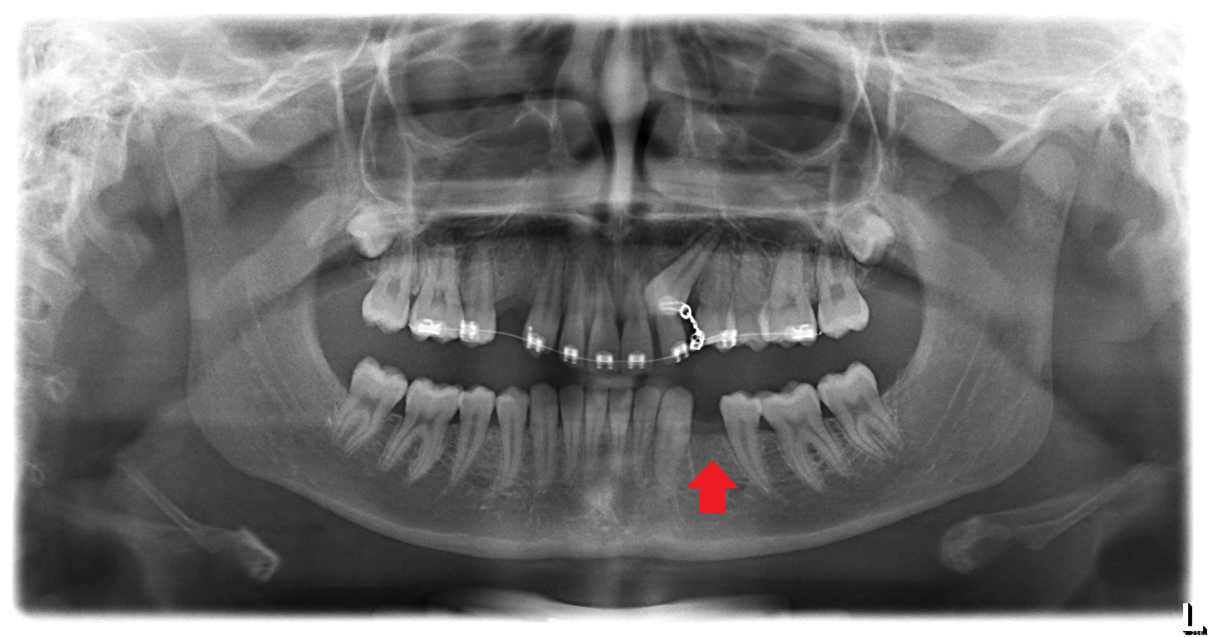 Panoramic X-Ray of Tooth Extraction