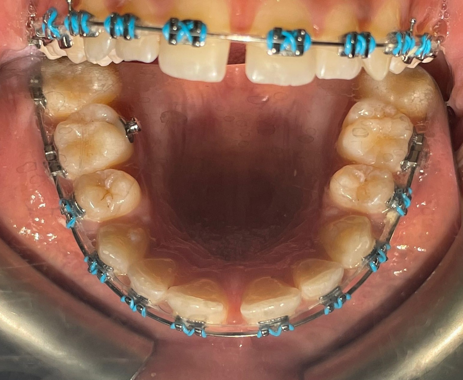 Braces still on in 2021 after years of treatment