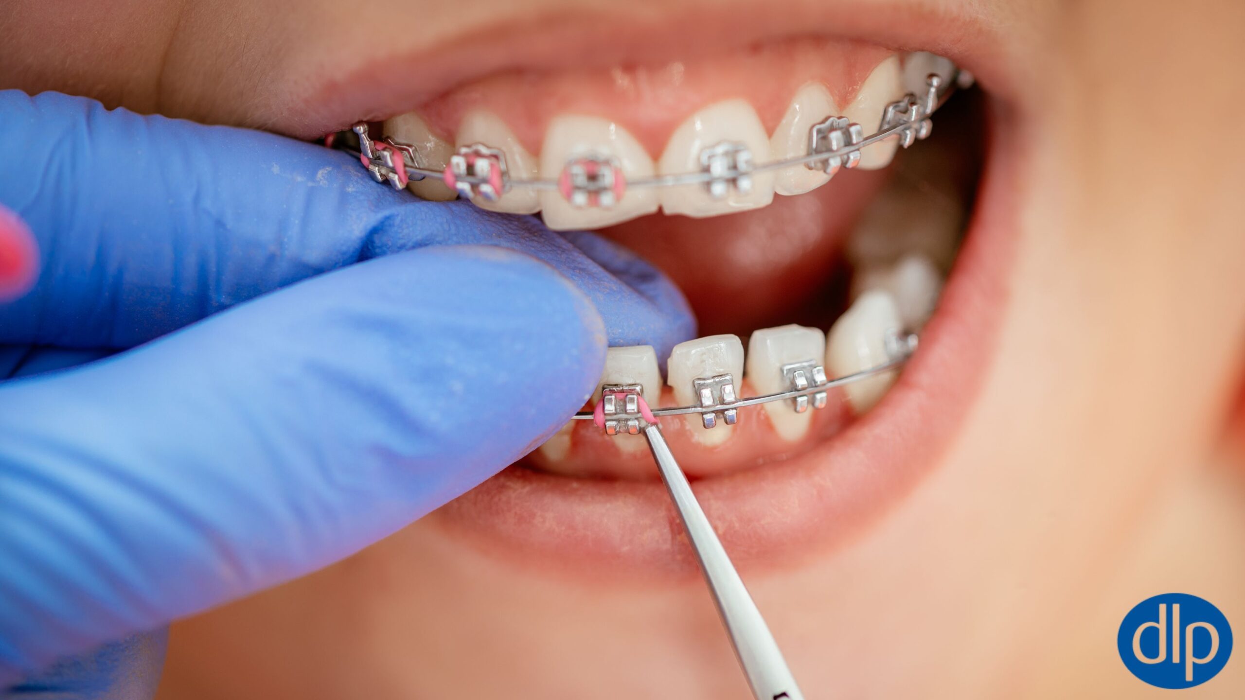 National Orthodontic Health Month: Tips for caring for your Braces