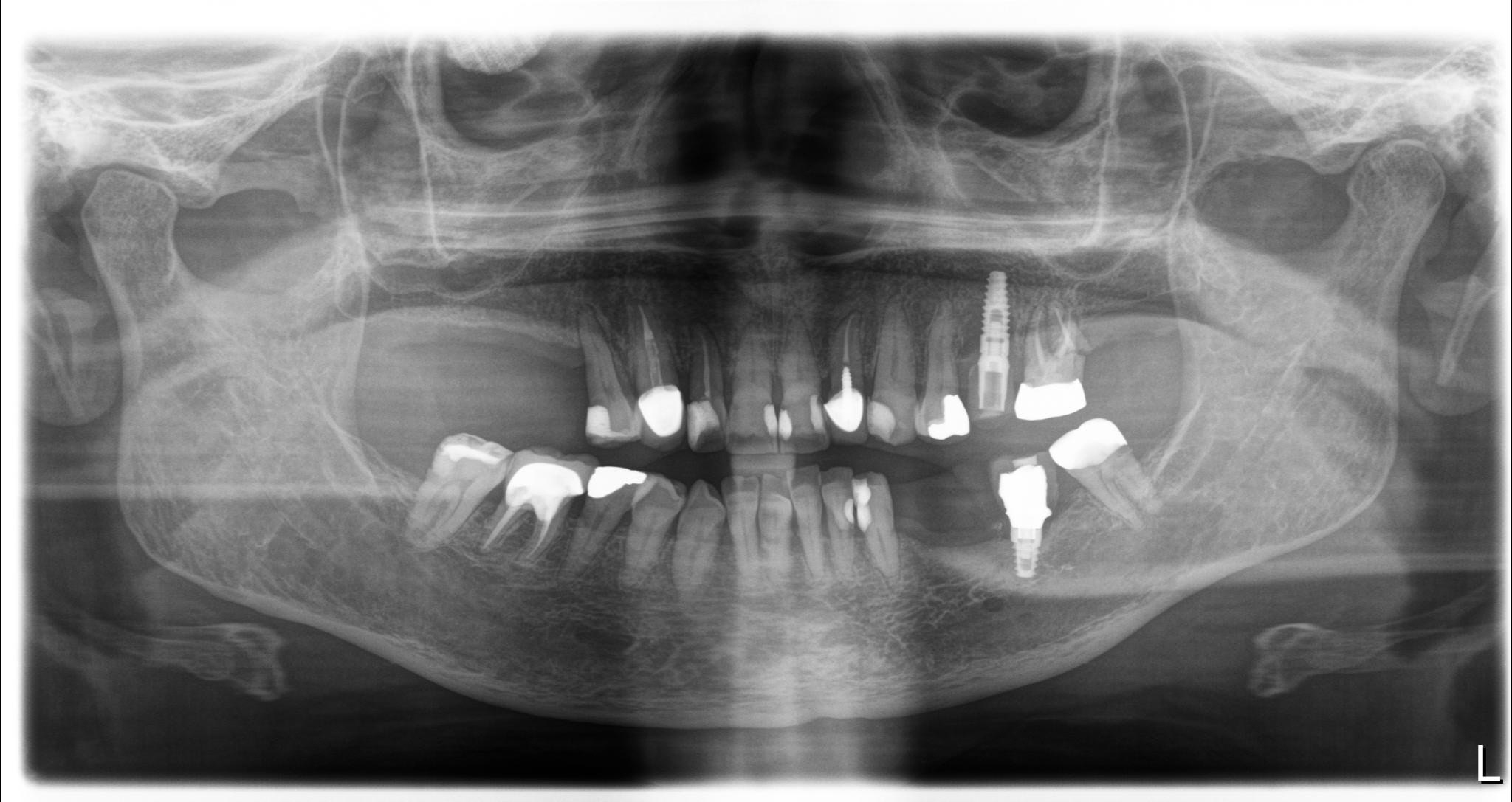 Panoramic dental x ray showing gum disease and dental decay Elizabeth Qashou