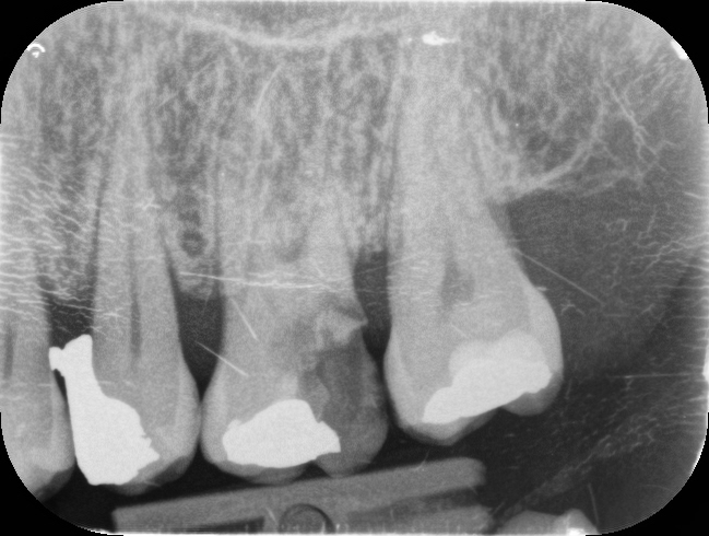 gross decay in upper left first molar Joanne Russell