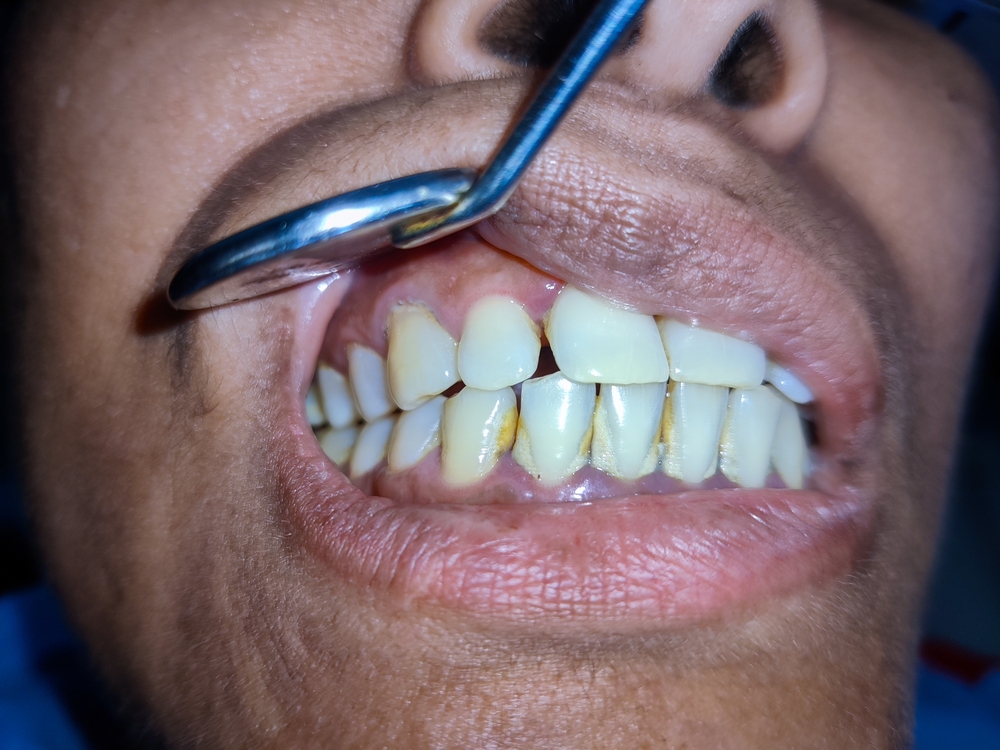 man with disease caused by poor oral hygiene