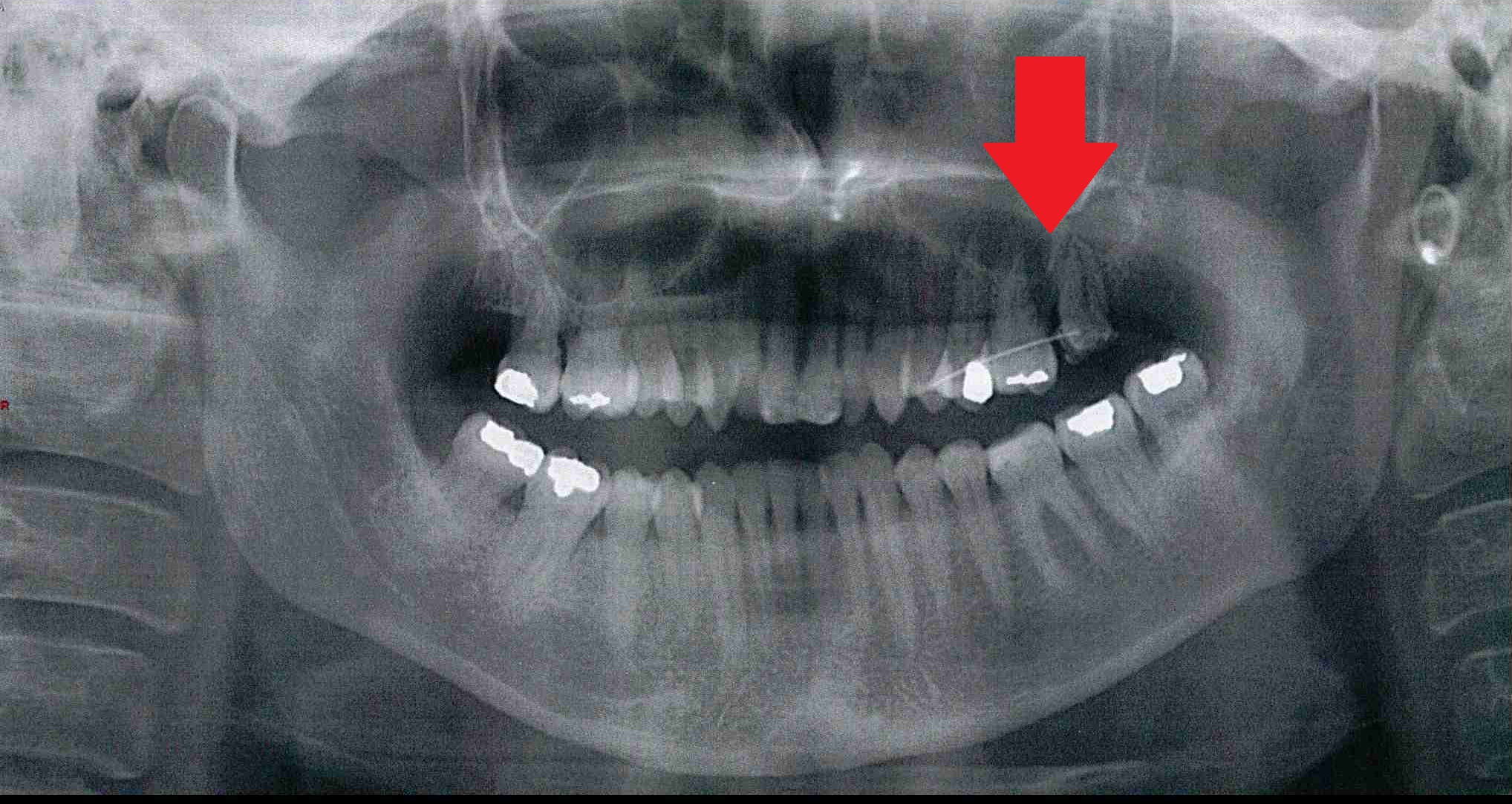 Fractured jaw and splinted upper left molar tooth
