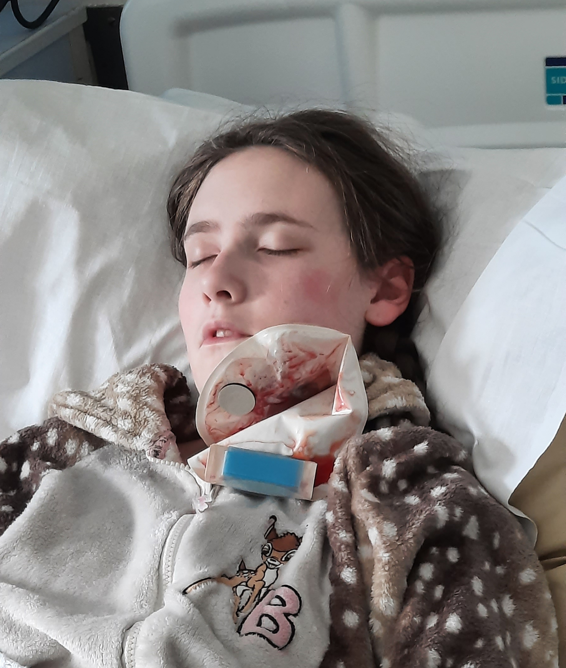 Tooth Decay Causing Tooth Loss