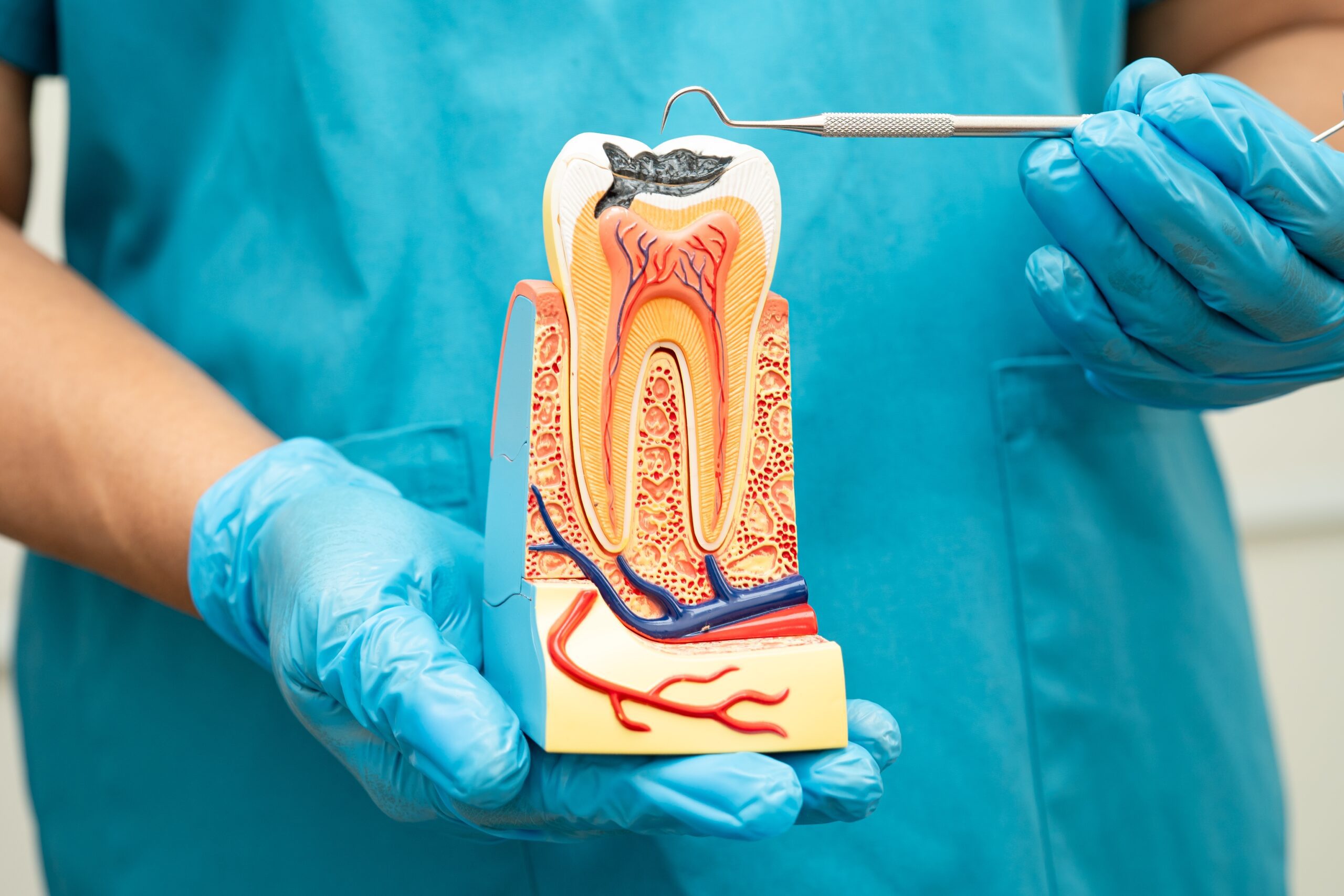 Dentist holding a model of a tooth and demonstrating nerve damage sustained after a root canal