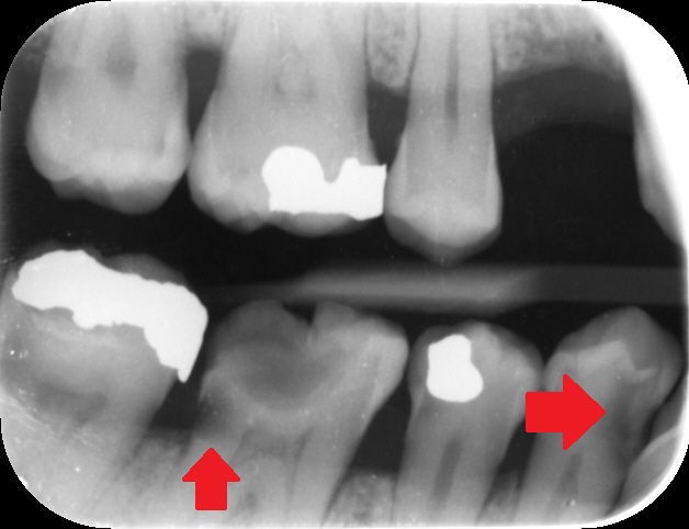 An x-ray image of untreated tooth decay, with red arrows pointing at the decay.