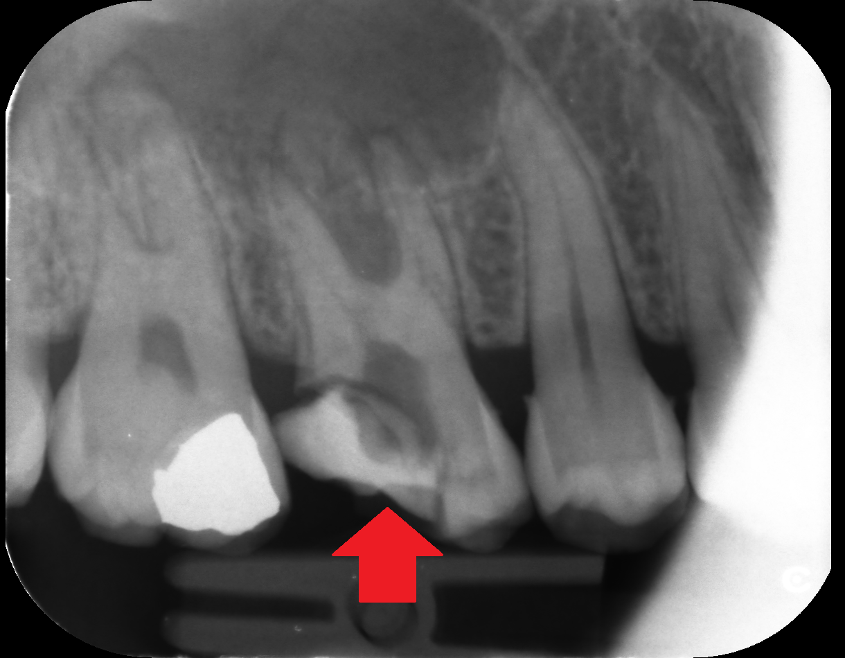 A dental x-ray with a red arrow pointing towards tooth decay and missed infections.