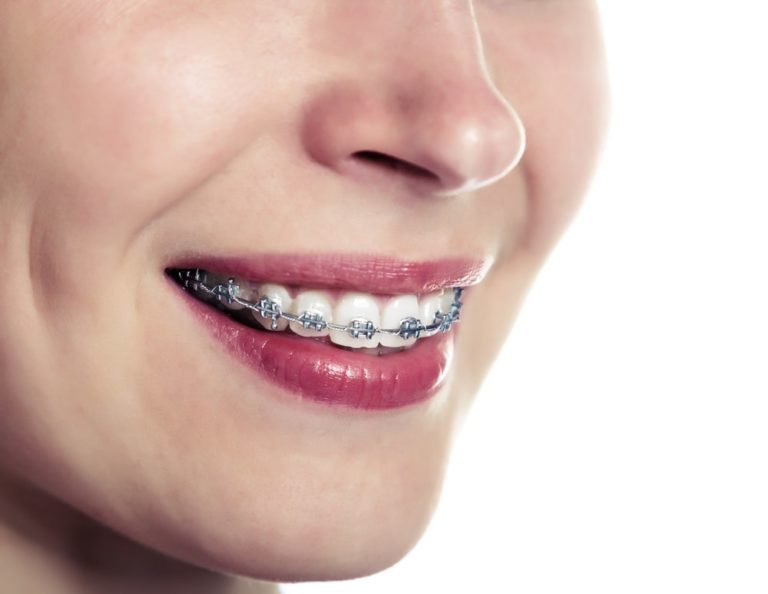Adult braces