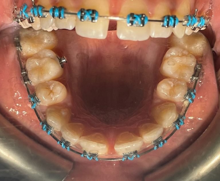 19-YEAR-OLD LONDONER AWARDED COMPENSATION FOR POOR ORTHODONTIC TREATMENT