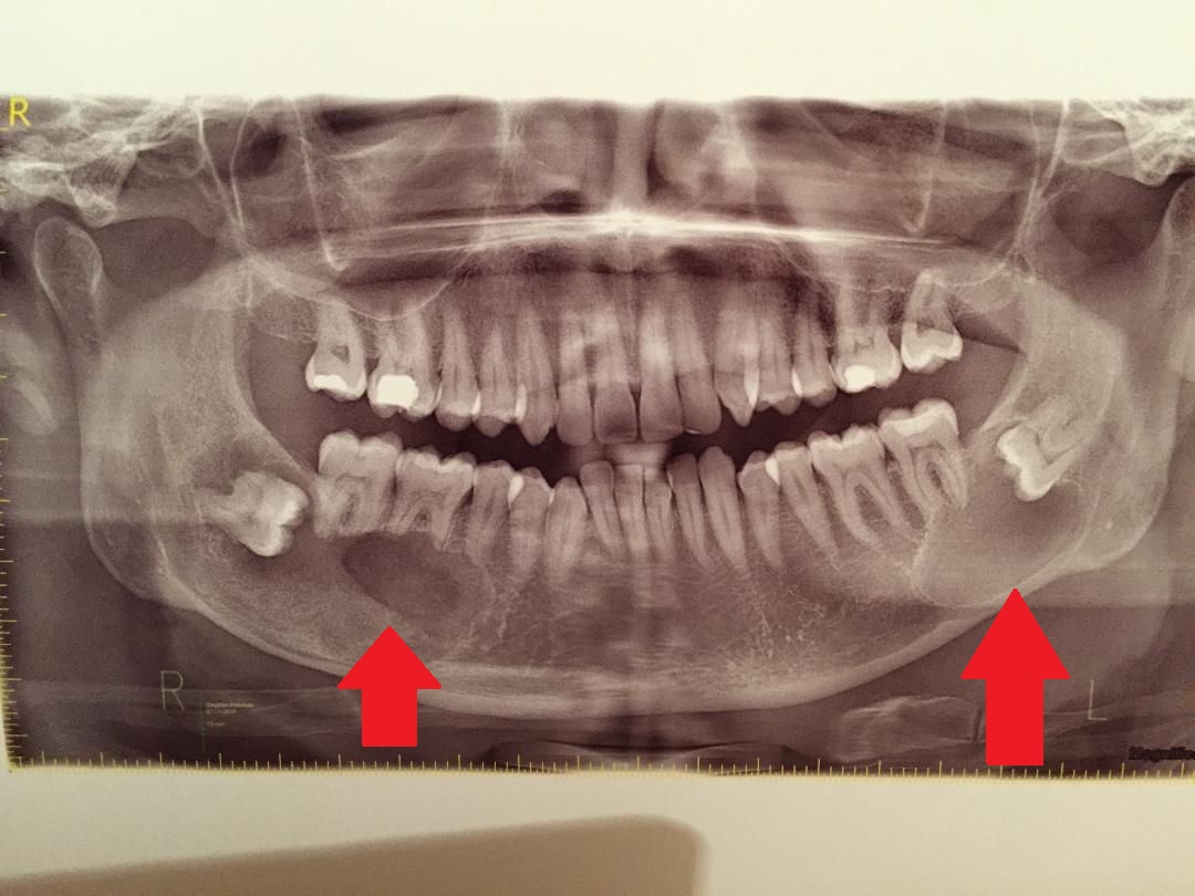 This image displays an x-ray of a patients jaw with two red arrows pointing at undiagnosed cysts in the jaw.