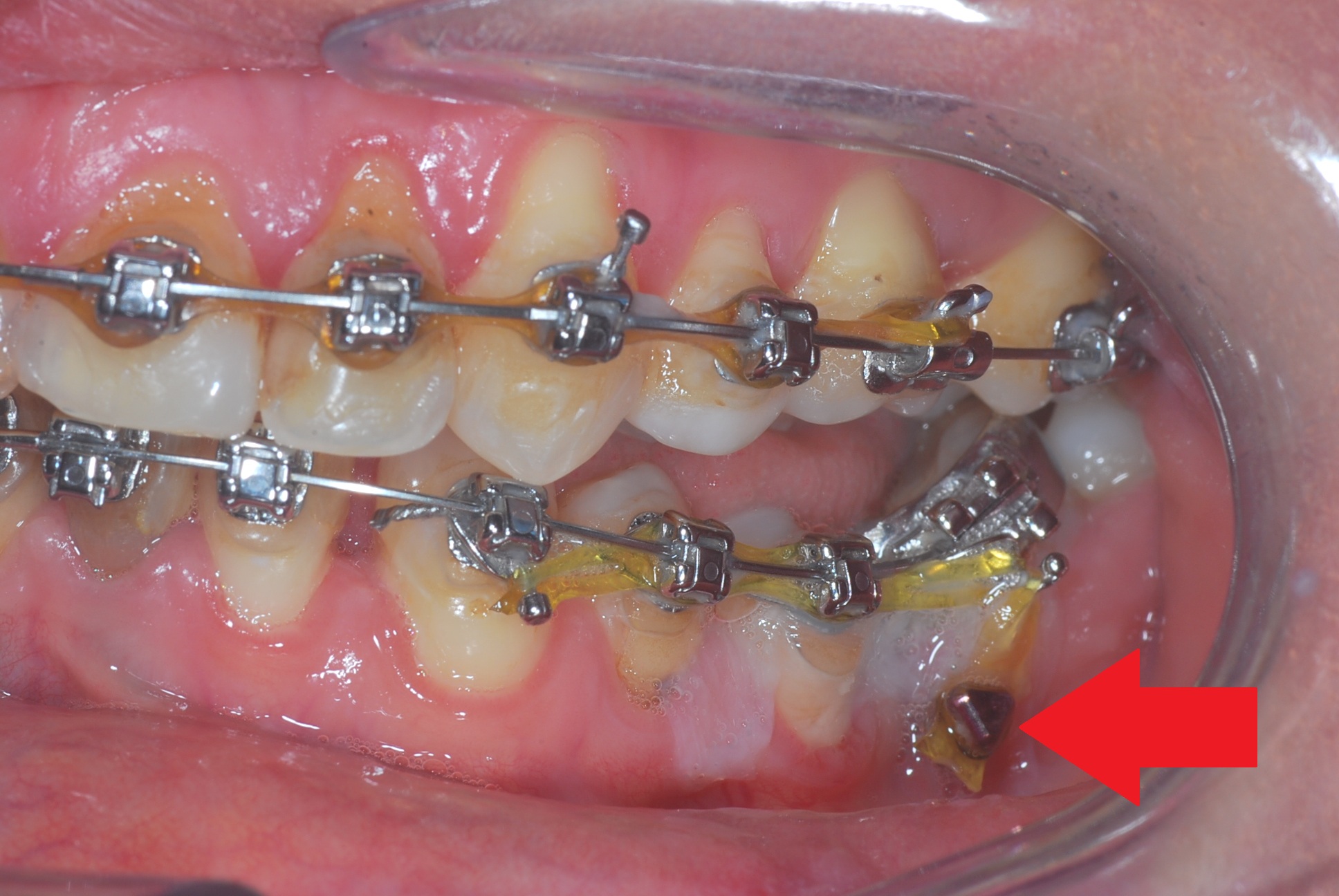 Close up image of a womans mouth with braces in. a red arrow points to an area that unnecessary damage has been caused.