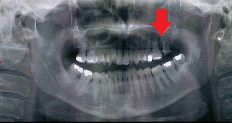 WOMAN AWARDED £10,000 AFTER DENTIST BROKE HER JAW DURING TOOTH EXTRACTION