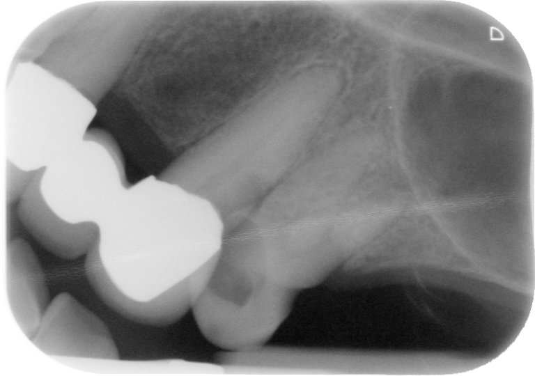 Retired Nurse Left In Agony After Dentist Botches Treatment