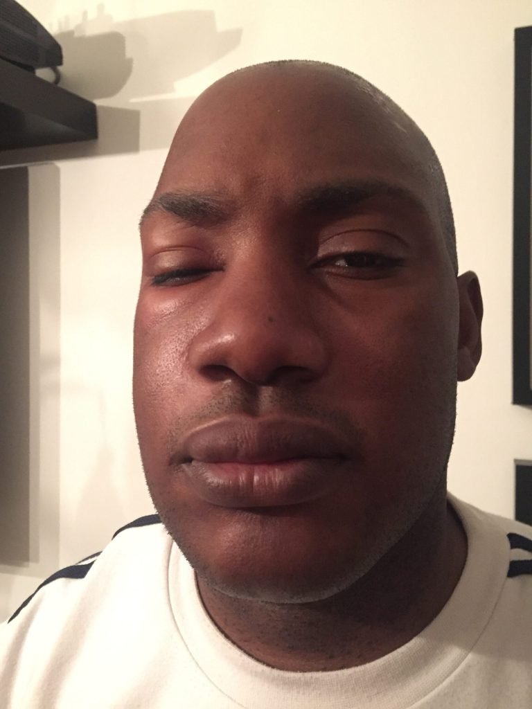 Man Suffers Agony And Loses Tooth After Botched Root Canal Treatment