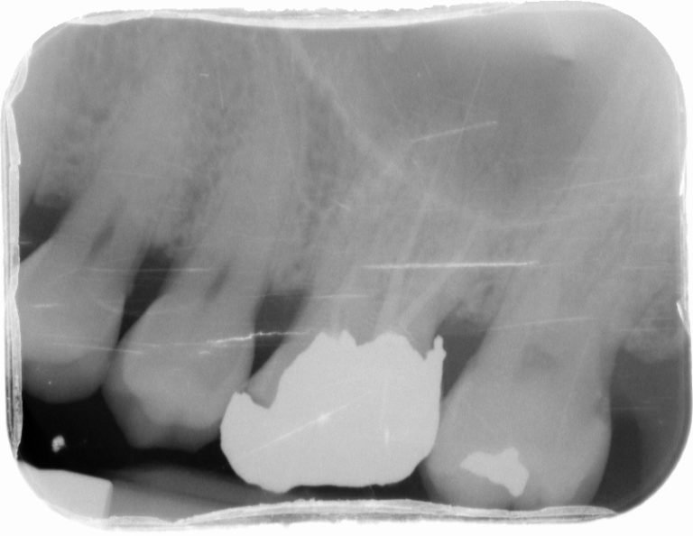 Local Lady Loses Tooth After Dentist’s Poor Root Canal Treatment
