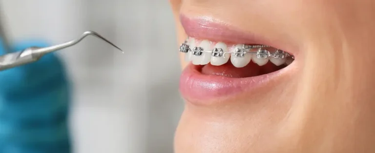 Dental Procedure Guide: Braces Fitting