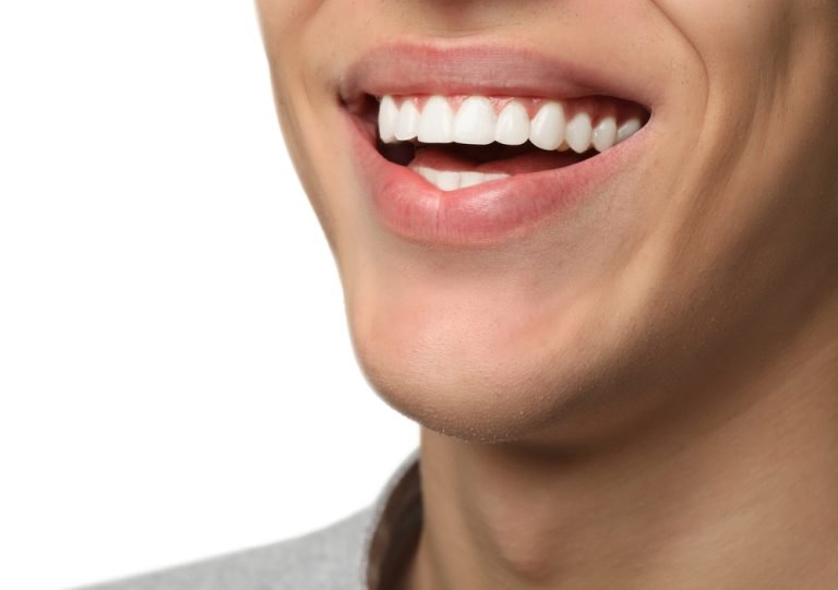 man smiling with permanent veneers
